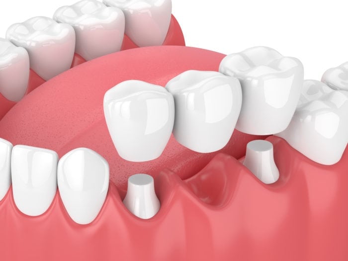 dental bridge in Boise, ID