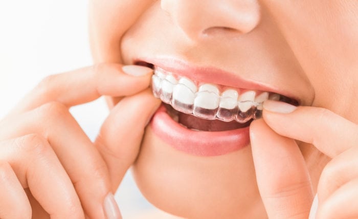 invisible braces boise id