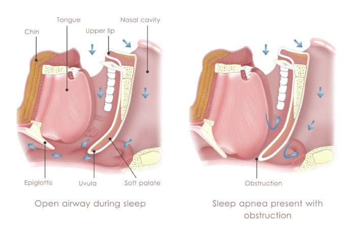 A diagram illustrating Obstruction Sleep Apnea (OSA). boise id sleep apnea treatment