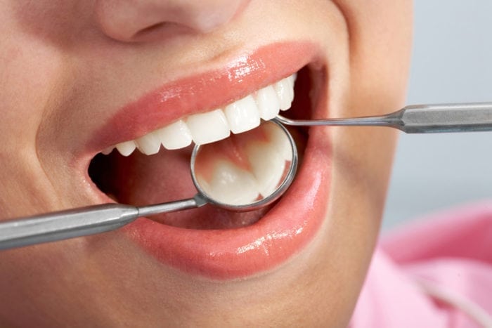 dental fillings