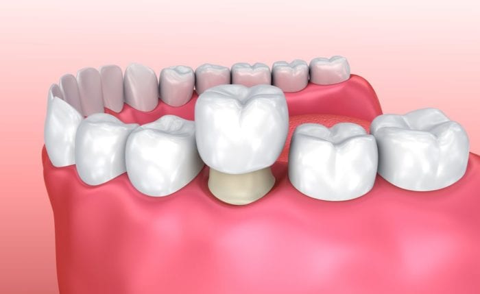 We can provide you with a dental crown in Boise, ID