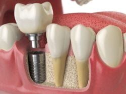 dental implants in boise, idaho