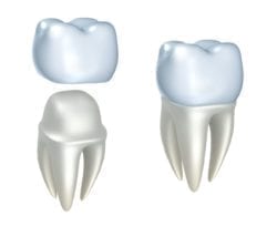 dental crowns in boise, idaho