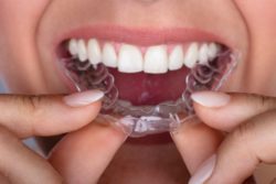 Invisible Braces in Boise ID