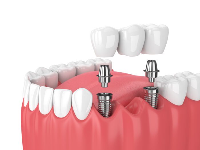 Implant Supported Dental Bridge in Boise, ID