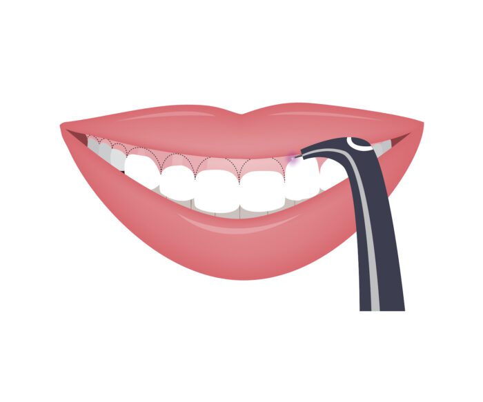 Laser Dentistry in Boise ID tends to be safe and effective for most dental conditions