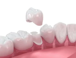 How We Make a Dental Crown in One Visit in Boise, ID